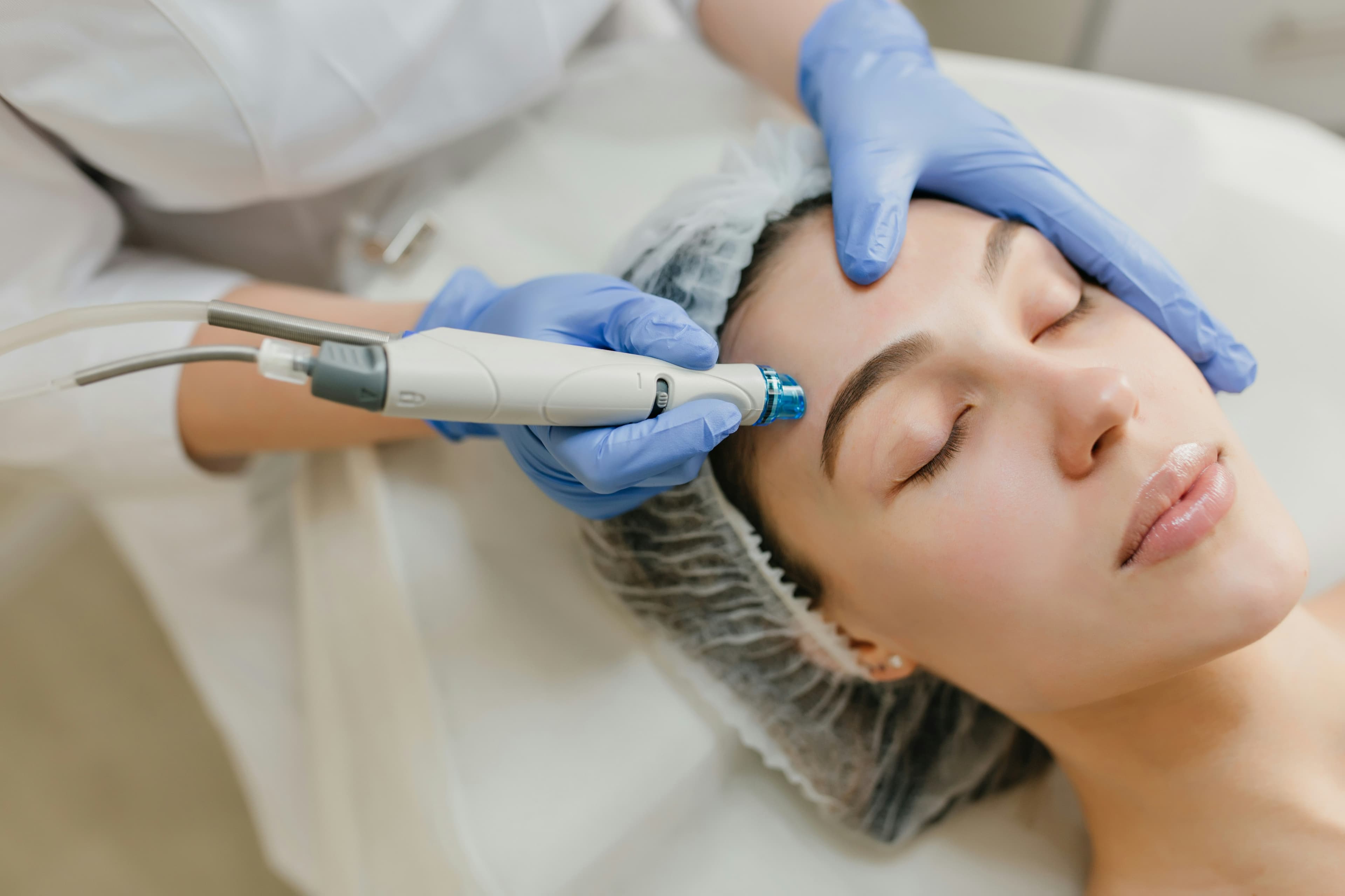 Facial microneedling treatment in progress